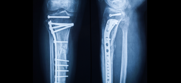 orthopeadics